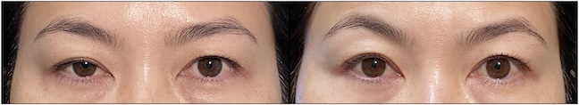 Before and After Image: Upper Blepharoplasty - front