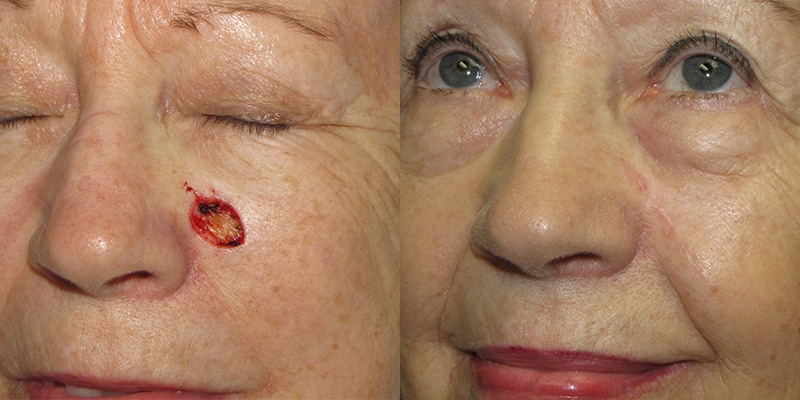 Before and After Image: Scar Treatments - left-front-oblique