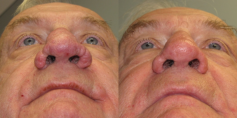 Before and After Image: Rhinophyma - front