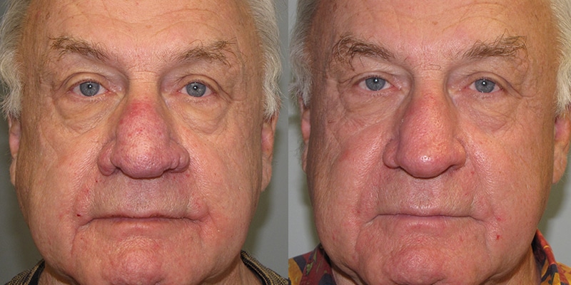 Before and After Image: Rhinophyma - front
