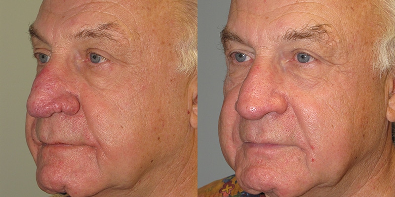 Before and After Image: Rhinophyma - left-front-oblique