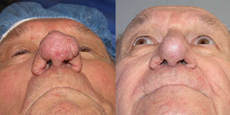 Before and After Image: Rhinophyma - front