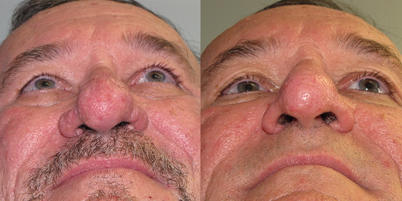 Before and After Image: Rhinophyma - front