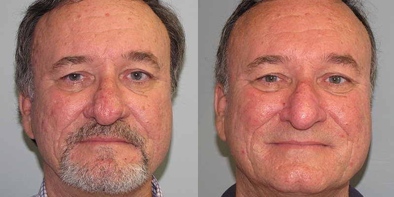 Before and After Image: Rhinophyma - front