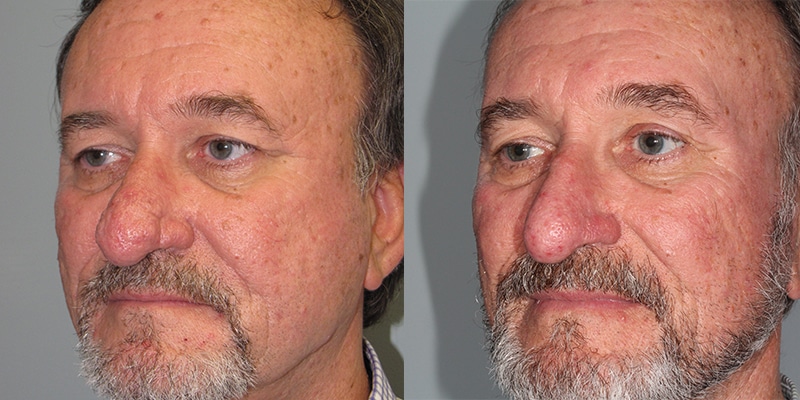 Before and After Image: Rhinophyma - left-front-oblique