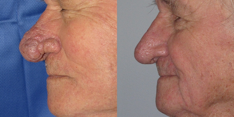 Before and After Image: Rhinophyma - left-side