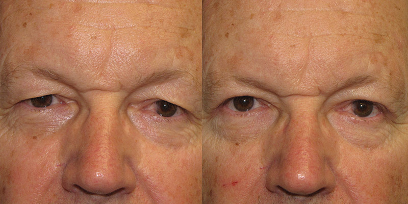 Before and After Image: Upper Blepharoplasty - front