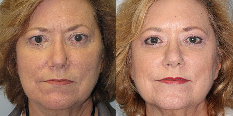 Before and After Image: Brow Lift - front