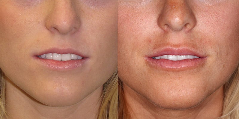 Before and After Image: Lip Enhancement - front