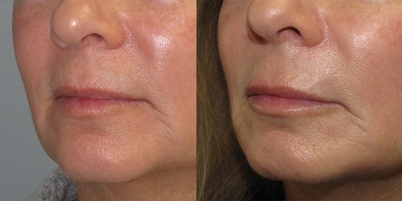 Before and After Image: Lip Enhancement - left-front-oblique