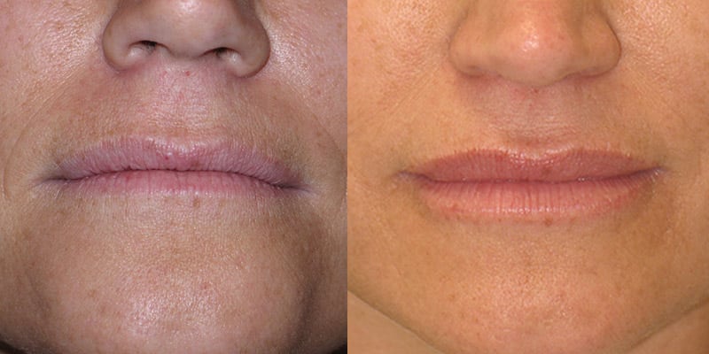 Before and After Image: Lip Enhancement - front