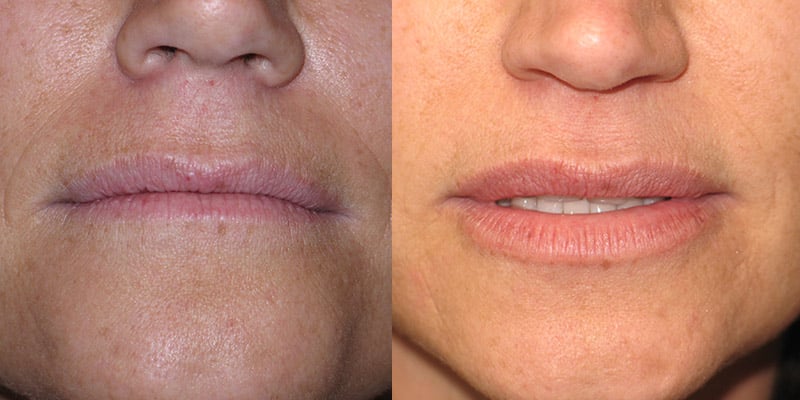 Before and After Image: Lip Enhancement - front