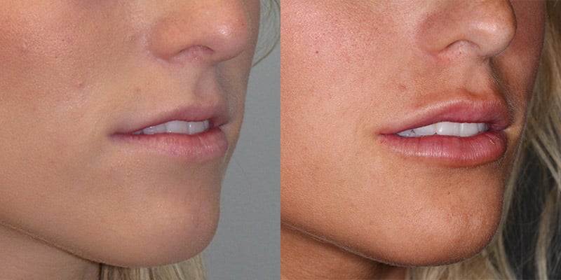 Before and After Image: Lip Enhancement - right-front-oblique