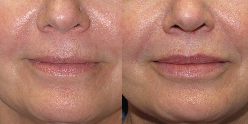 Before and After Image: Lip Enhancement - front