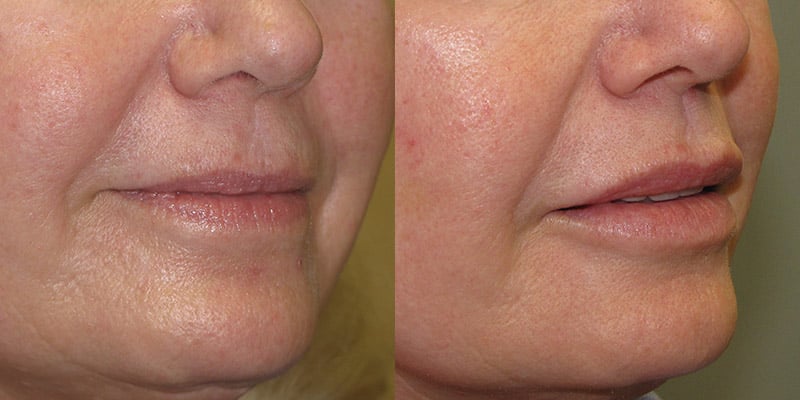 Before and After Image: Lip Enhancement - right-front-oblique