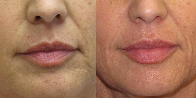 Before and After Image: Lip Enhancement - right-front-oblique