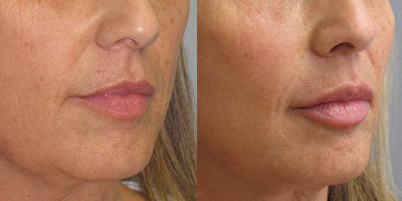 Before and After Image: Lip Enhancement - right-front-oblique