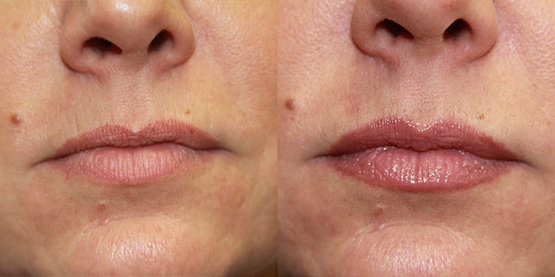 Before and After Image: Lip Enhancement - front