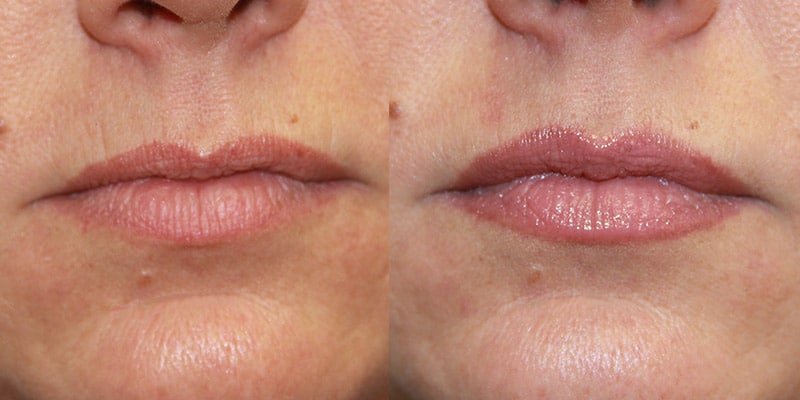 Before and After Image: Lip Enhancement - front