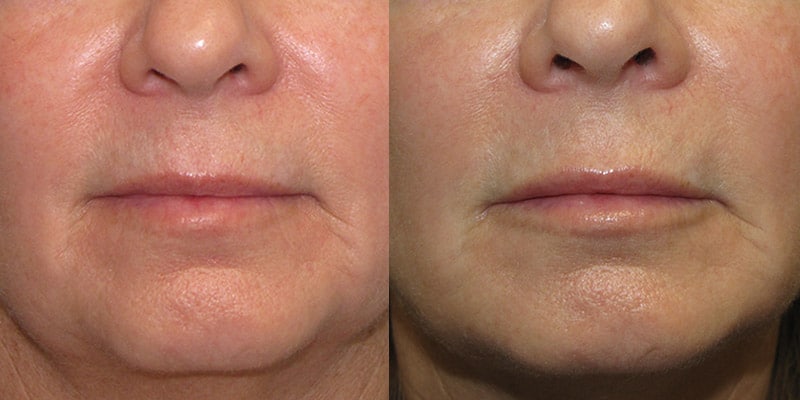 Before and After Image: Lip Enhancement - front