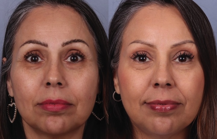 Before and After Image: Botox & Fillers - front