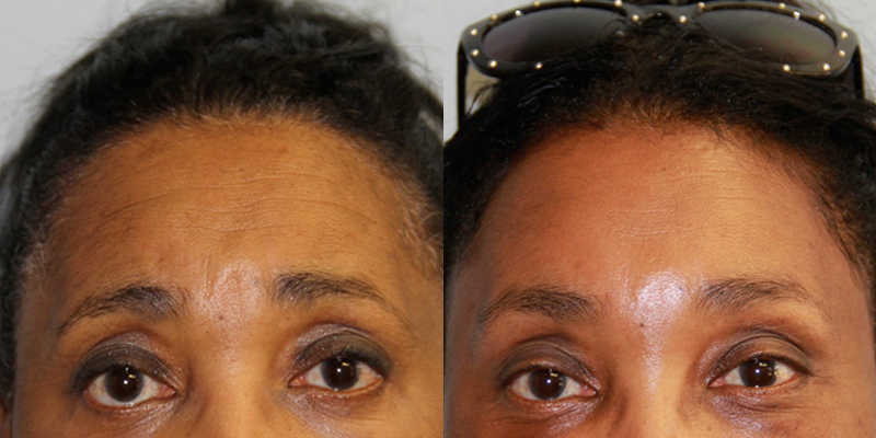 Before and After Image: Brow Lift - front