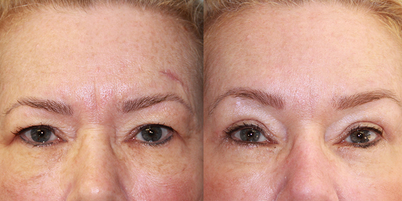 Before and After Image: Brow Lift - front