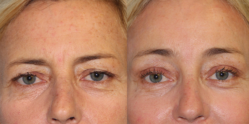 Before and After Image: Brow Lift - front
