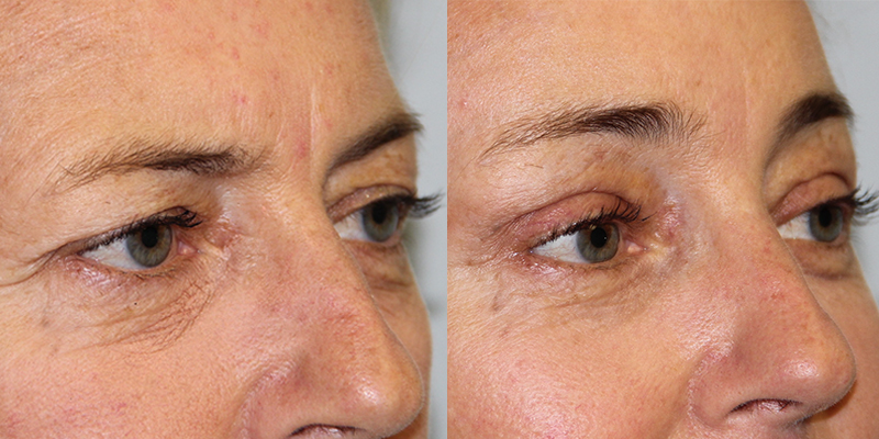 Before and After Image: Brow Lift - right-front-oblique