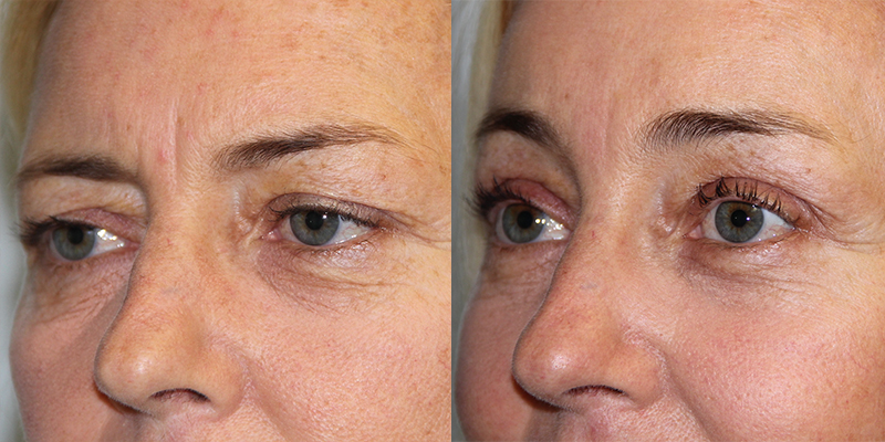 Before and After Image: Brow Lift - left-front-oblique