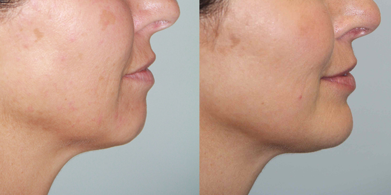 Before and After Image: Chin Surgery, Submentoplasty - right-side