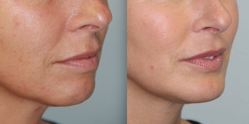Before and After Image: Chin Surgery, Submentoplasty - right-front-oblique