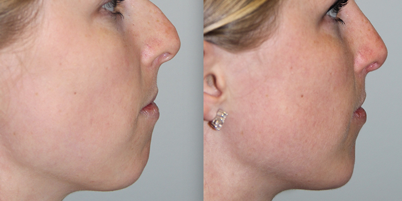 Before and After Image: Chin Surgery, Submentoplasty - right-side