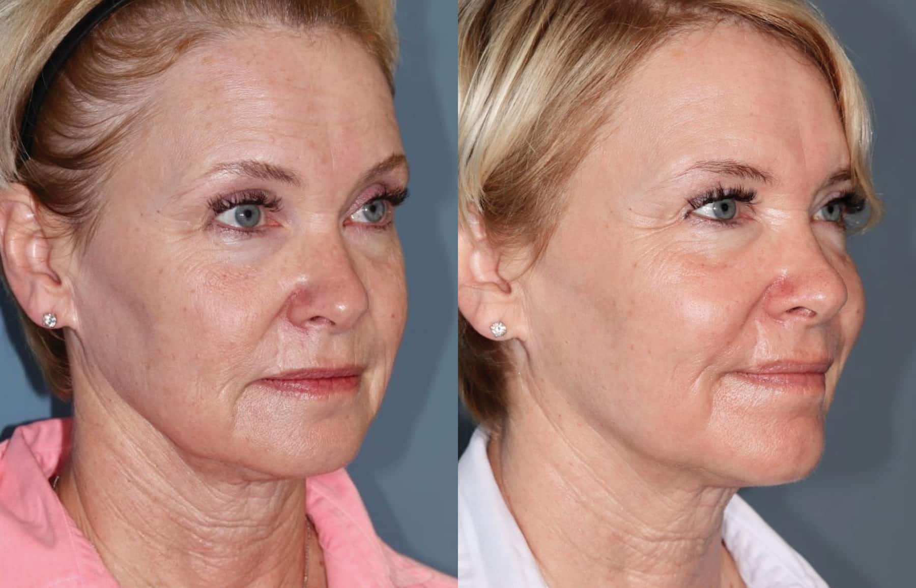 Before and After Image: CO2 Laser Resurfacing - right-front-oblique