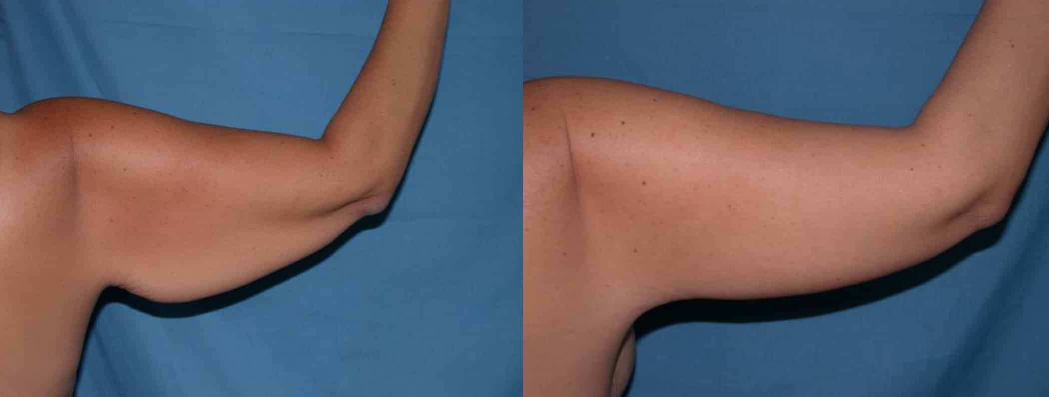 Before and After Image: Arm Lift - back