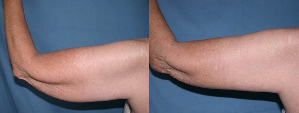 Before and After Image: Arm Lift - back