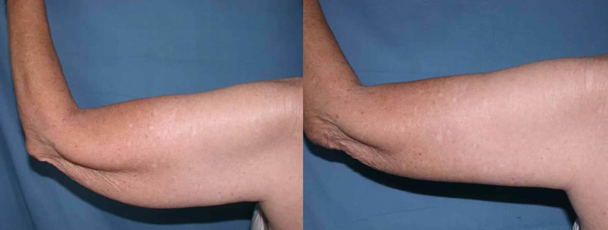 Before and After Image: Arm Lift - back