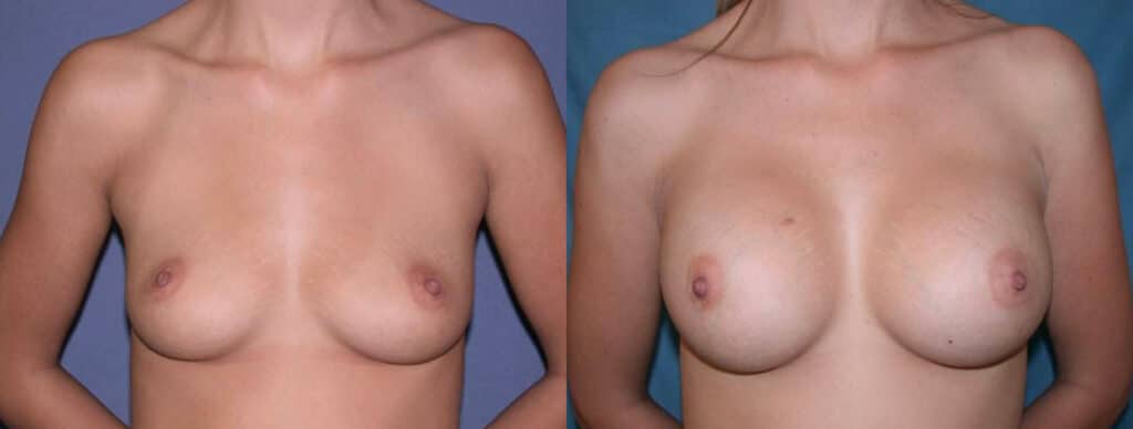 Before and After Image: Breast Augmentation with Saline - front