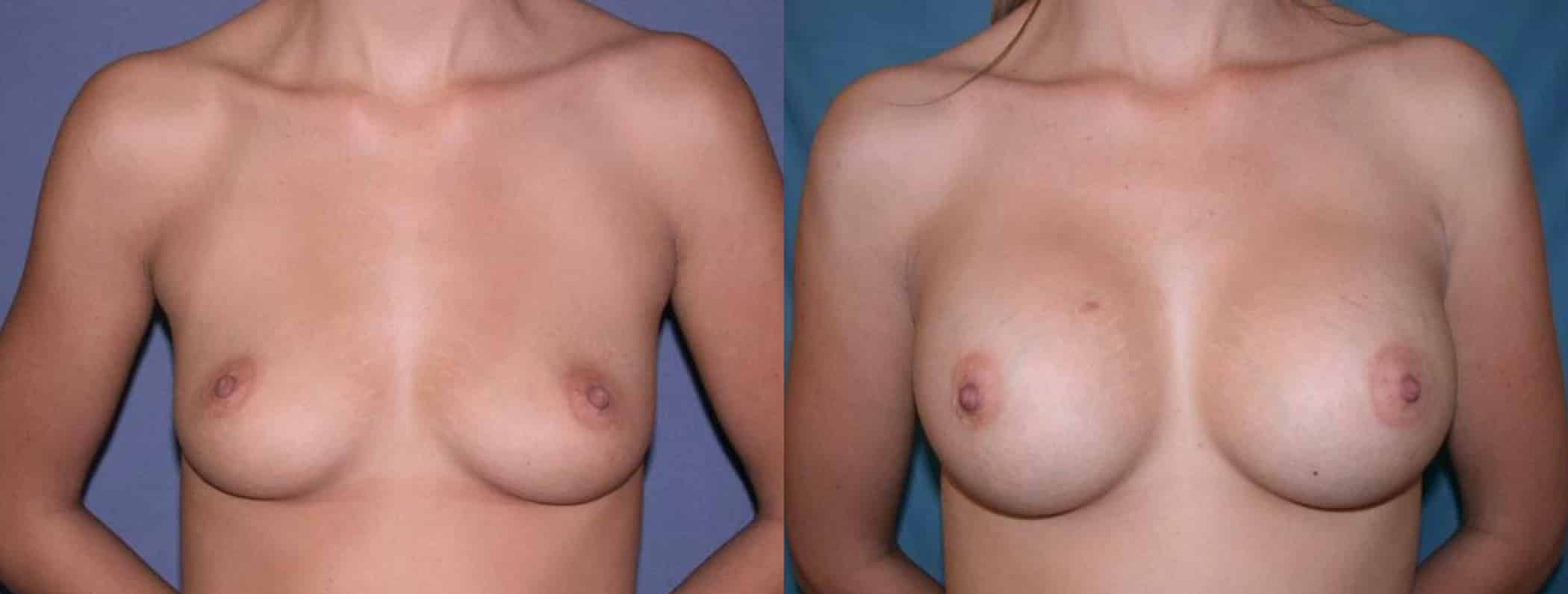 Before and After Image: Breast Augmentation with Saline - front