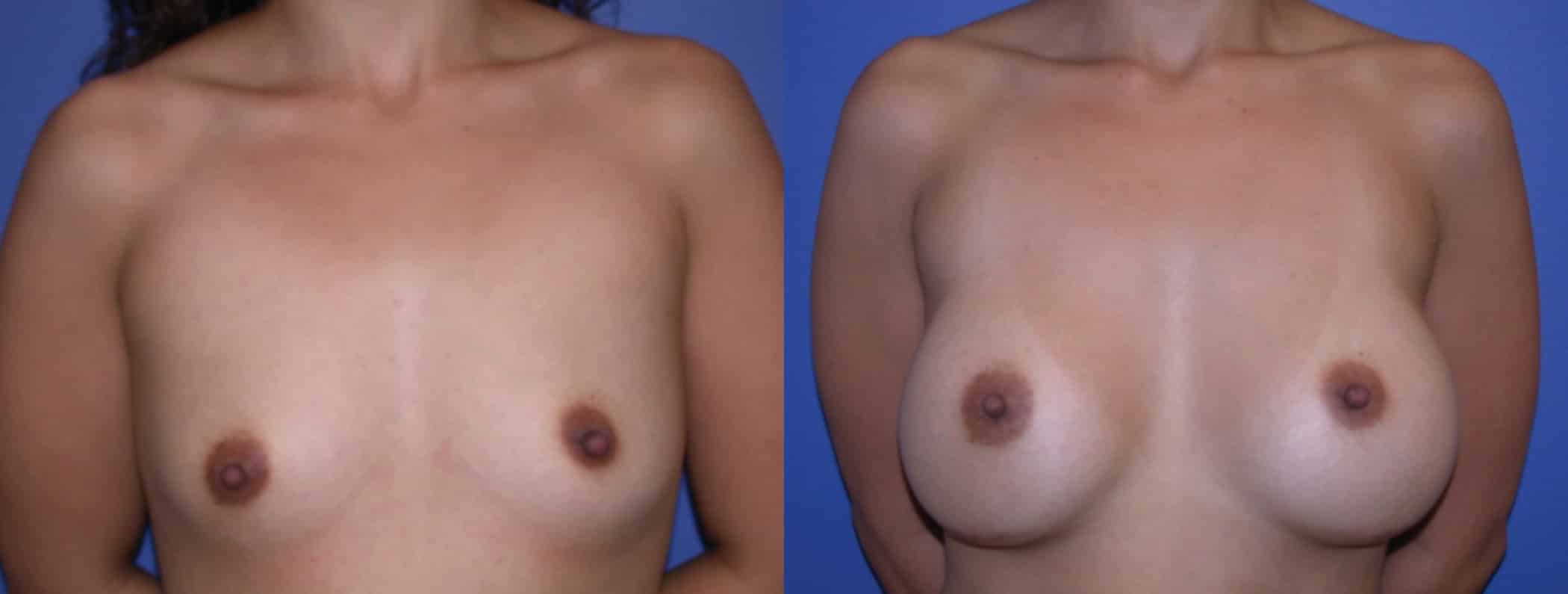 Before and After Image: Breast Augmentation with Saline - front
