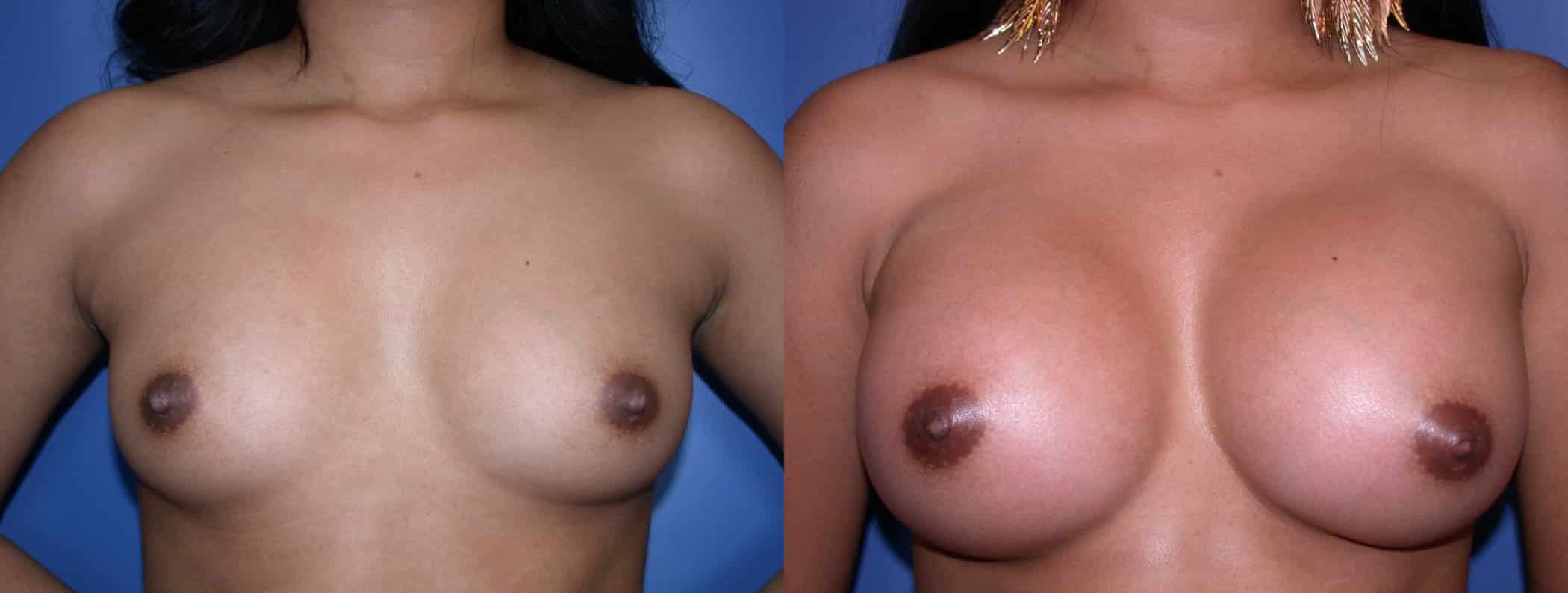 Before and After Image: Breast Augmentation with Saline - front