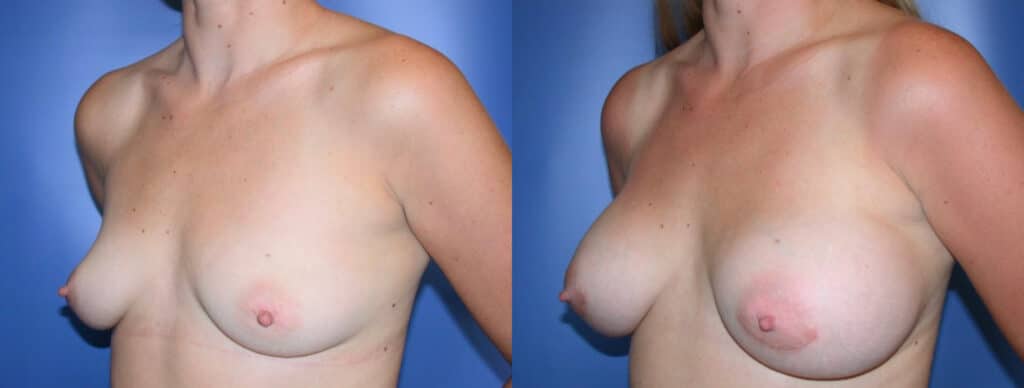 Before and After Image: Breast Augmentation with Saline - left-front-oblique