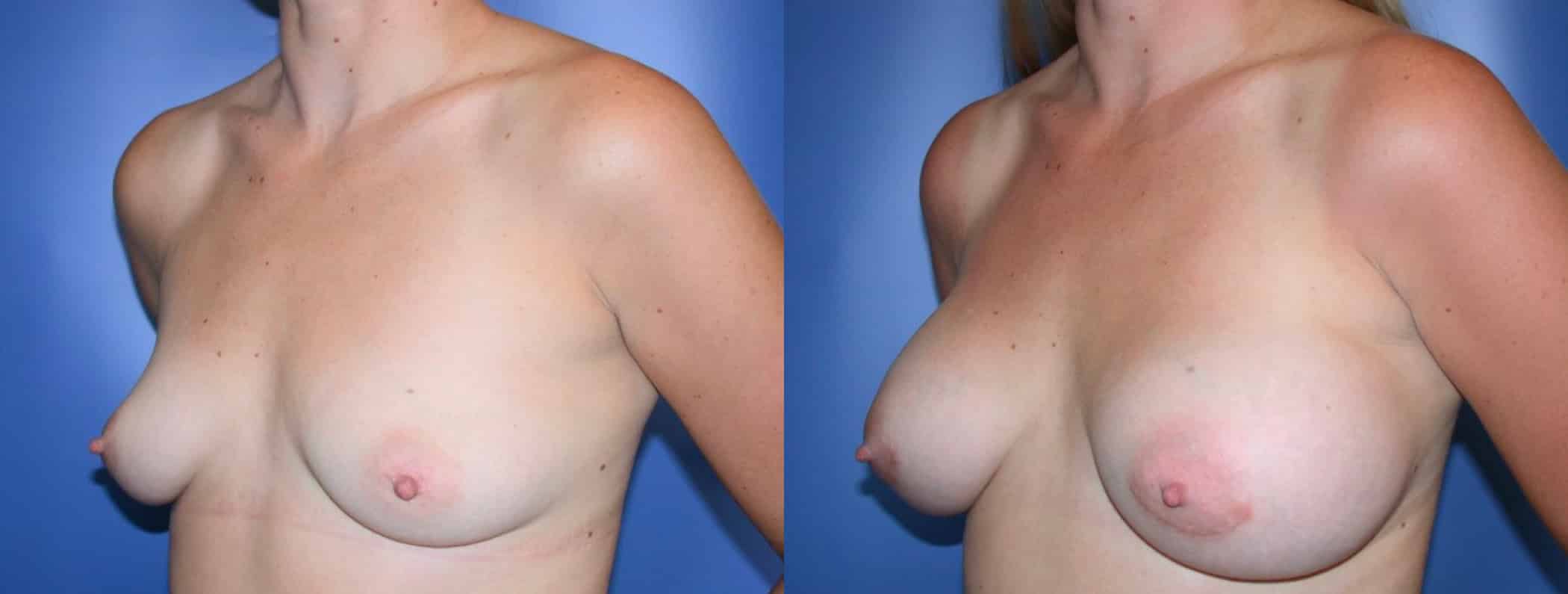 Before and After Image: Breast Augmentation with Saline - left-front-oblique