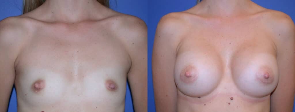 Before and After Image: Breast Augmentation with Saline - front