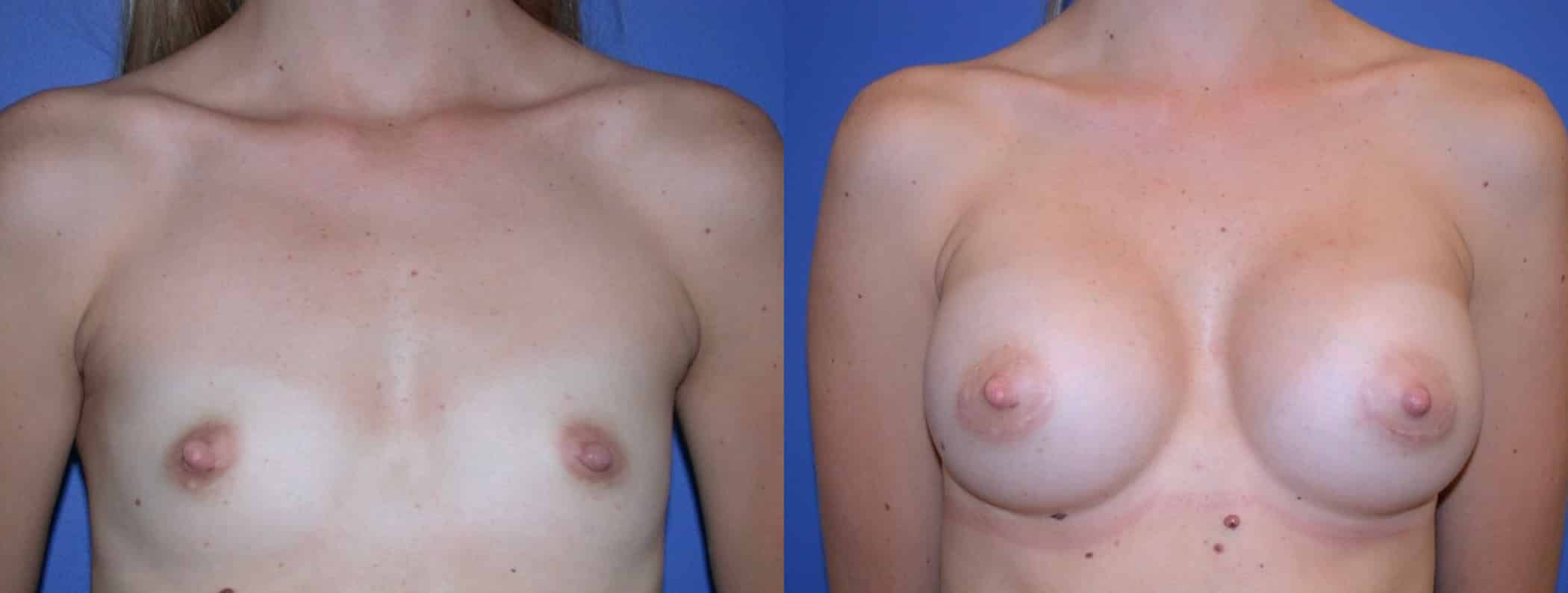 Before and After Image: Breast Augmentation with Saline - front