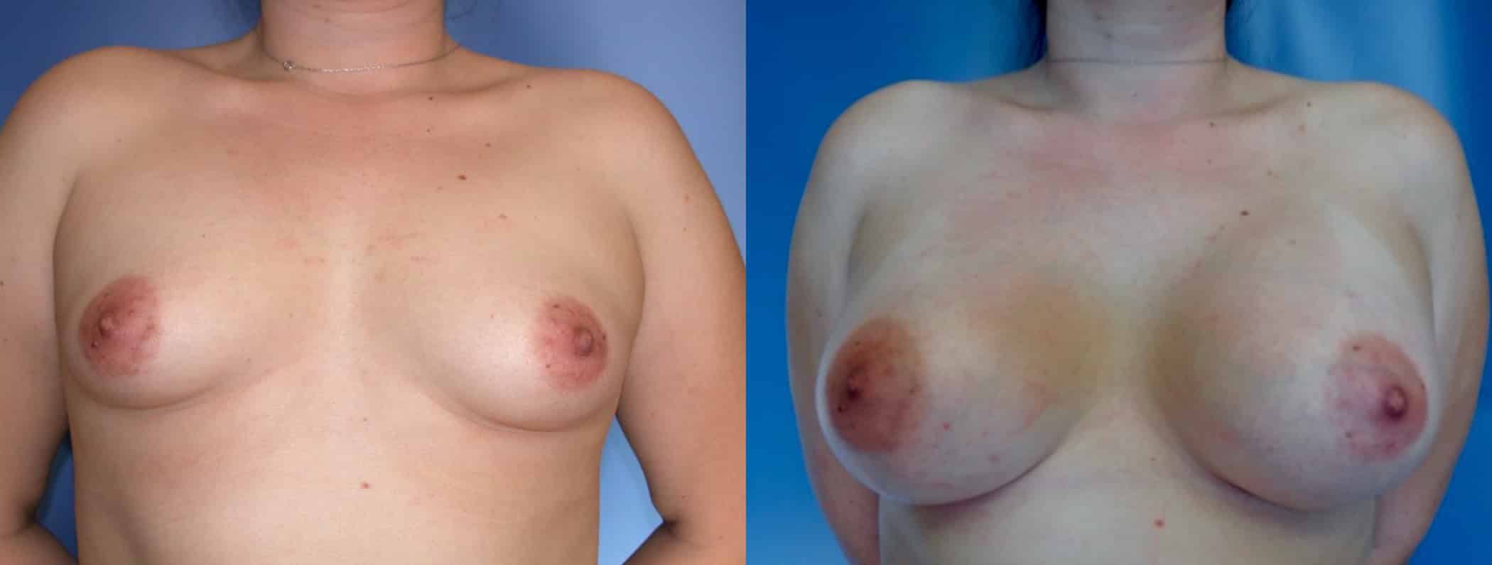 Before and After Image: Breast Augmentation with Saline - front