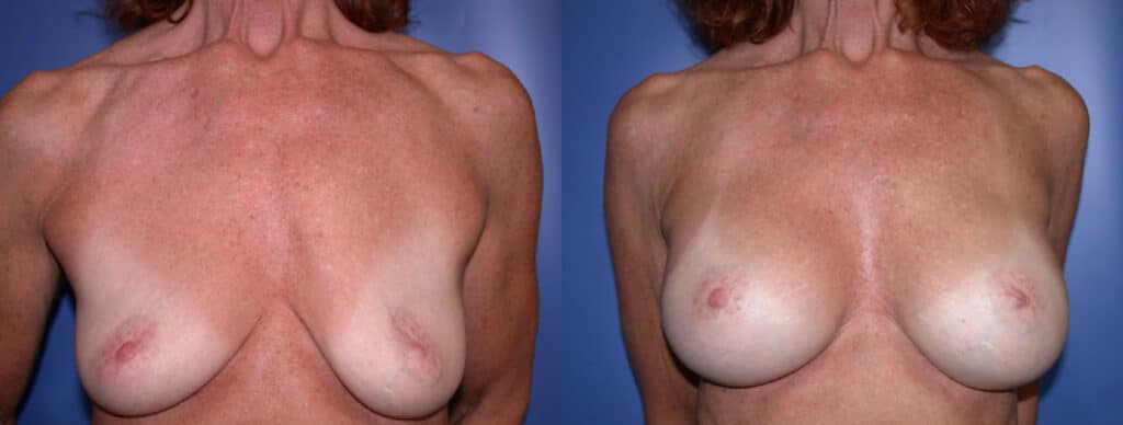 Before and After Image: Breast Augmentation with Silicone - front