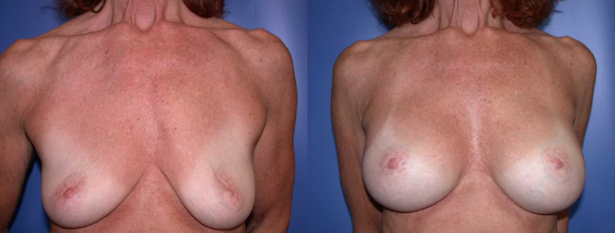 Before and After Image: Breast Augmentation with Silicone - front