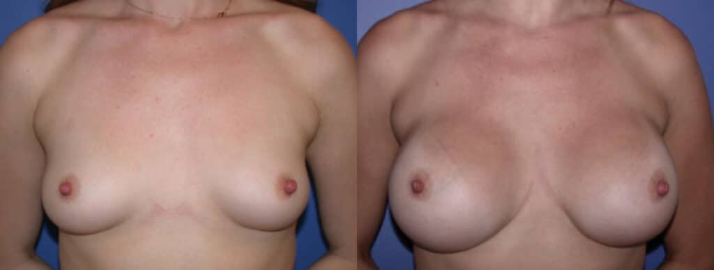 Before and After Image: Breast Augmentation with Silicone - front