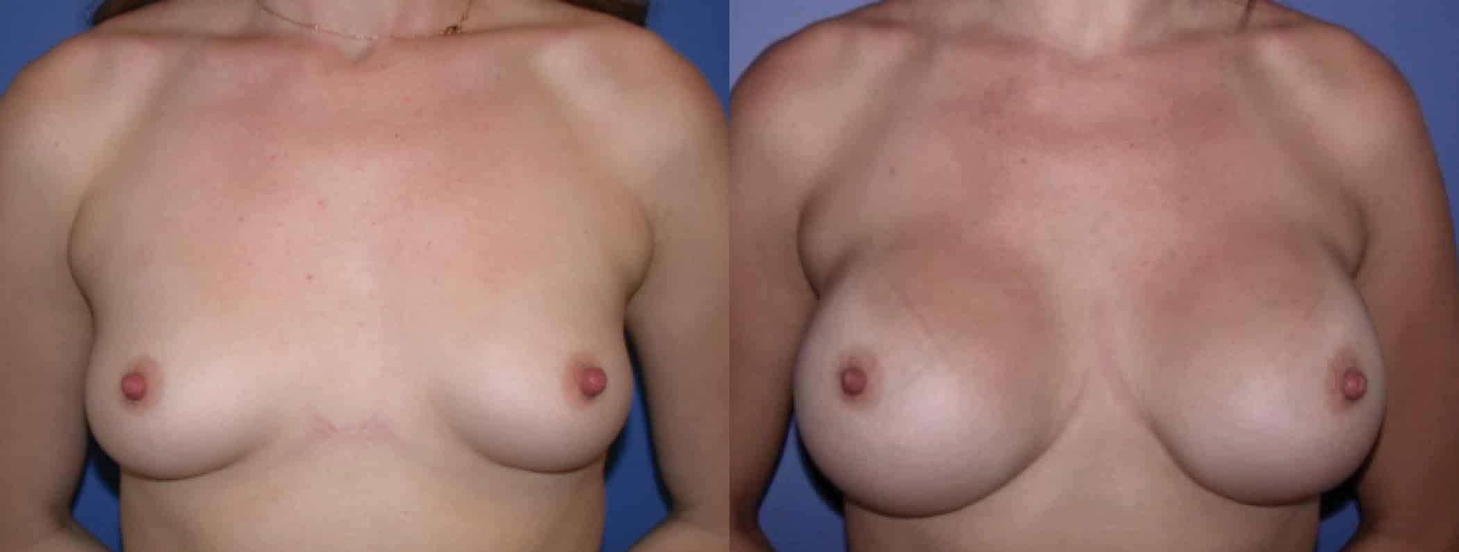 Before and After Image: Breast Augmentation with Silicone - front